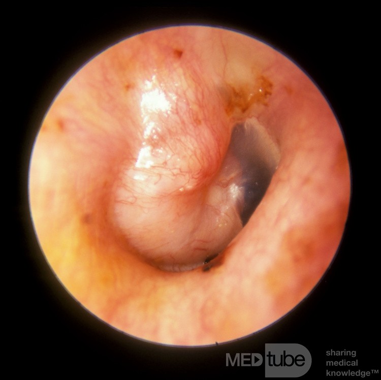 Adenoma primario del oído medio
