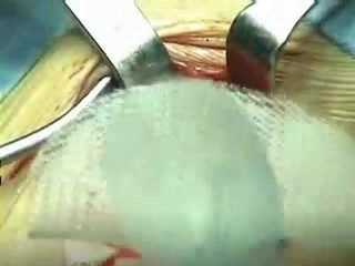 PHS (Sistema de Hernia Prolene) - reparación de hernia femoral