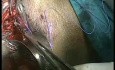 Vaginoplastia laparoscópica