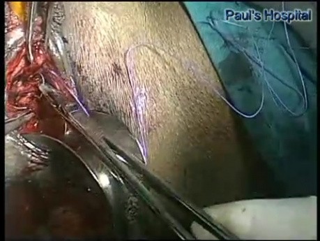 Vaginoplastia laparoscópica