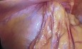 Hernioplastia inguinal escrotal laparoscopica TAPP