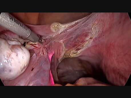 HTL (histerectomía total laparoscópica) con stent ureteral