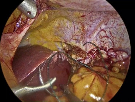Reparación laparoscópica con malla de la eventración del diafragma