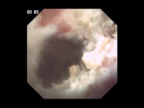 RIRS bilateral multietapa