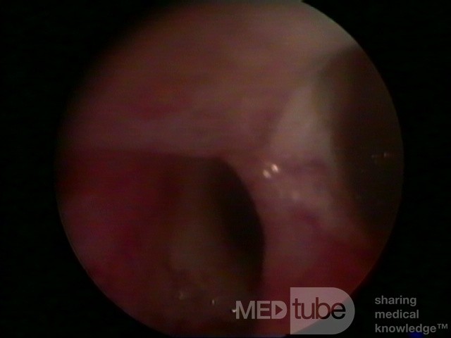 Septo uterino visto en la histeroscopia