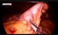 Gastrectomía en manga con reparación de hernia