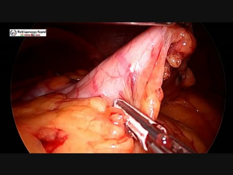 Gastrectomía en manga con reparación de hernia