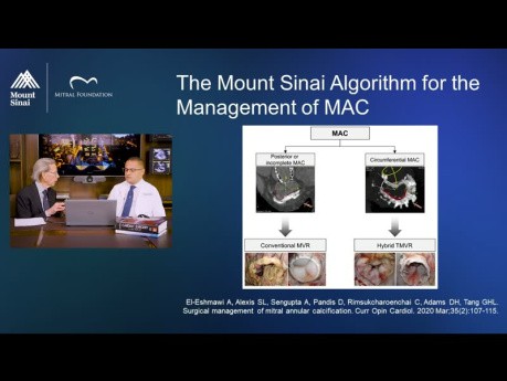 Calcificación del anillo mitral - Ahmed El-Eshmawi