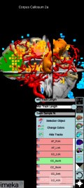 Planificación quirúrgica con neuronavegador en paciente con lesión de masa intracraneal. Glioma de alto grado.