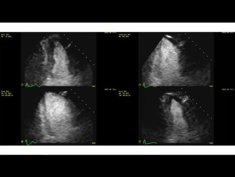 Principios de evaluación de isquemia de la ecocardiografía de estrés y casos clínicos.