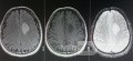 Planificación quirúrgica con neuronavegador en paciente con lesión de masa intracraneal. Glioma de alto grado.