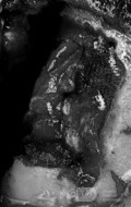 Estirpación de cavernoma subcortical 