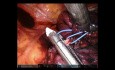 Pequeño tumor pulmonar en S3 (segmento anterior del lóbulo superior izquierdo)