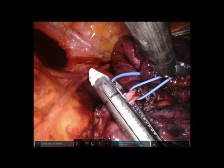 Pequeño tumor pulmonar en S3 (segmento anterior del lóbulo superior izquierdo)