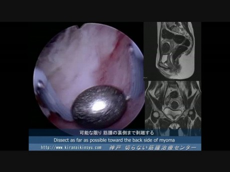 Técnica histeroscópica con bola rodante para el mioma submucoso del fondo uterino