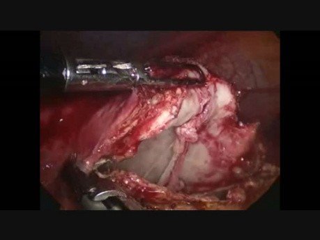 Extracción laparoscópica de un quiste hidatídico 