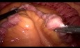 Bypass gástrico por laparoscopia