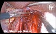 Miotomía laparoscópica de Heller: técnica de estiramiento y desgarro