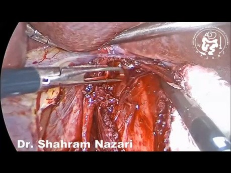 Miotomía laparoscópica de Heller: técnica de estiramiento y desgarro