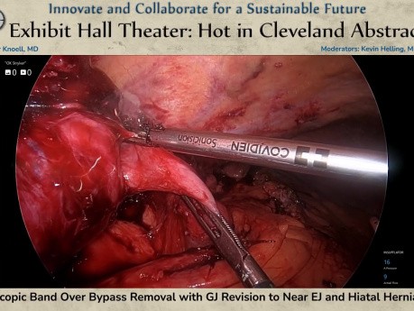 Retirada laparoscópica de banda sobre bypass gástrico, con revisión de la anastomosis gastro-yeyunal a una anastomosis casi esófago-yeyunal y reparación de hernia de hiato.