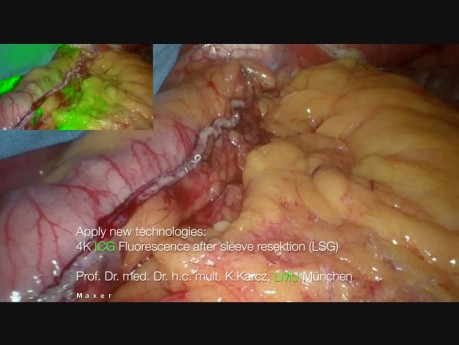 Fluorescencia con verde indocianina de su ángulo por resección gástrica en manga