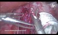 Cirugía de acalasia: movilización del hemihígado izquierdo dividiendo el ligamento triangular para exponer el esófago inferior