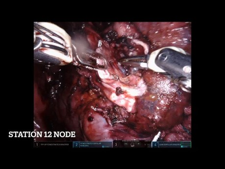 Segmentectomía pulmonar robótica derecha S2+6