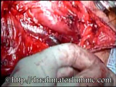 Ligadura de la vena yugular interna