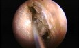 Etmoidectomía anterior - endoscopia