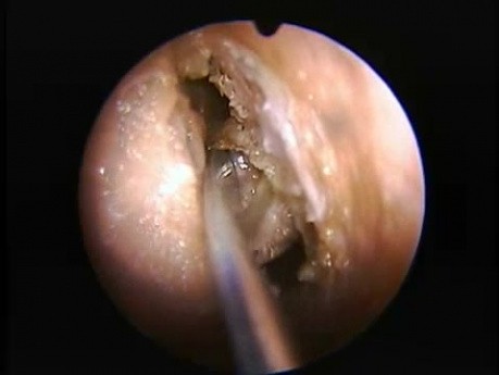 Etmoidectomía anterior - endoscopia