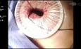Pleuroscopia & Biopsia