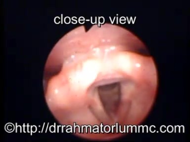 Rima Glottis después de cordectomía transoral con láser de CO2 tipo III: la visión laríngea