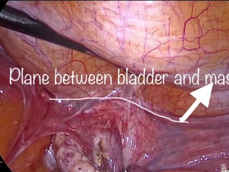 Extirpación de fibroides de ligamento ancho después de la histerectomía