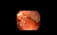 Clip sobre el osciloscopio para gastrectomía en manga con el cierre de la fístula 