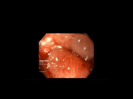 Clip sobre el osciloscopio para gastrectomía en manga con el cierre de la fístula 