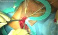 Cirugía de esfínter artificial en incontinencia masculina