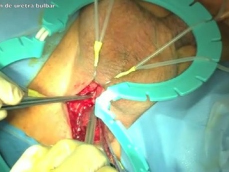 Cirugía de esfínter artificial en incontinencia masculina