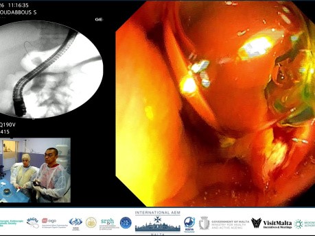 Cuando una endoscopia revela tres diagnósticos