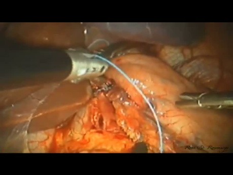De la laparoscopia convencional a la miotomía de Heller de sitio único laparoscópico (LESS) para la acalasia