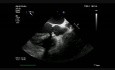 Endocardits infecciosa de la válvula aortica bicúspide