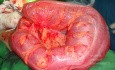 Vólvulo sigmoideo (1)