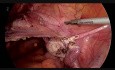 HTL con stent de uréter