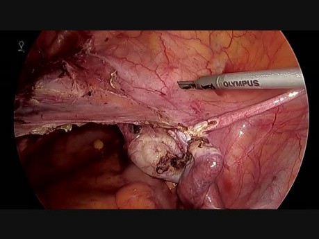 HTL con stent de uréter