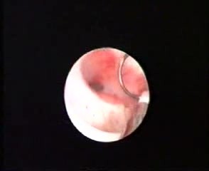 Ablación endometrial histeroscópica