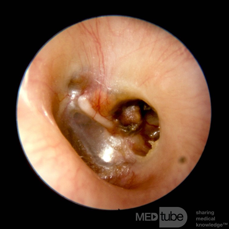 Granuloma de colesterol en el oído medio