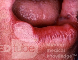 Carcinoma de células escamosas del labio
