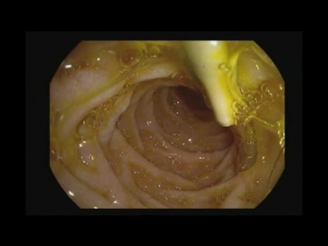 Extracción del stent del conducto biliar común