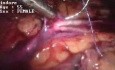 Pieloplastia laparoscópica - paciente femenina