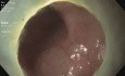 Disección submucosa endoscópica de un tumor rectal lateral diseminado