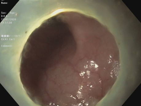 Disección submucosa endoscópica de un tumor rectal lateral diseminado